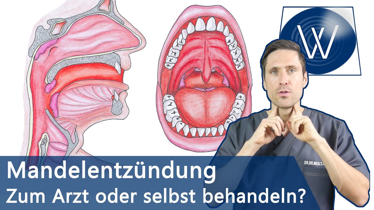 Mandelentzündung