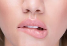 lippenkrebs frühstadium bilder